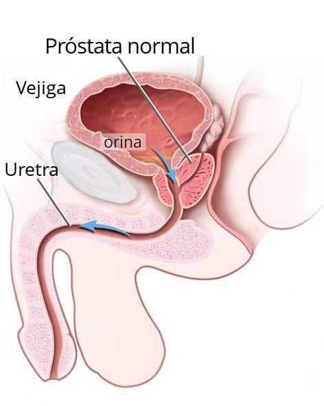 A prostatitis alatt fut