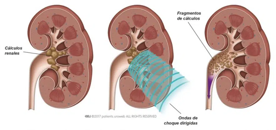 C lico Renal Fundaci n Jos Ram n De La Morena