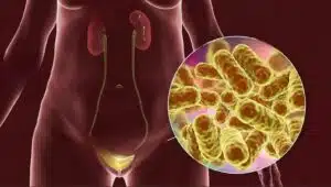 cistitis